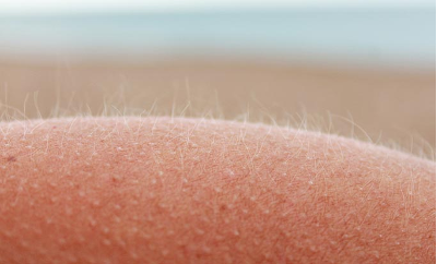 Peach fuzz from minoxidil migration